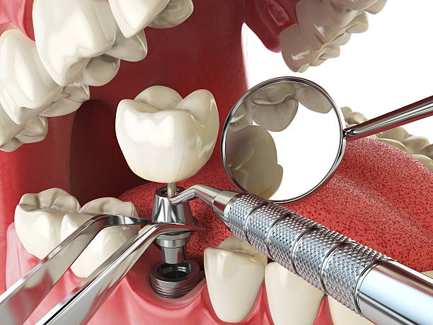 Best Emergency Dental Care for Broken or Chipped Teeth in Nicollet, MN